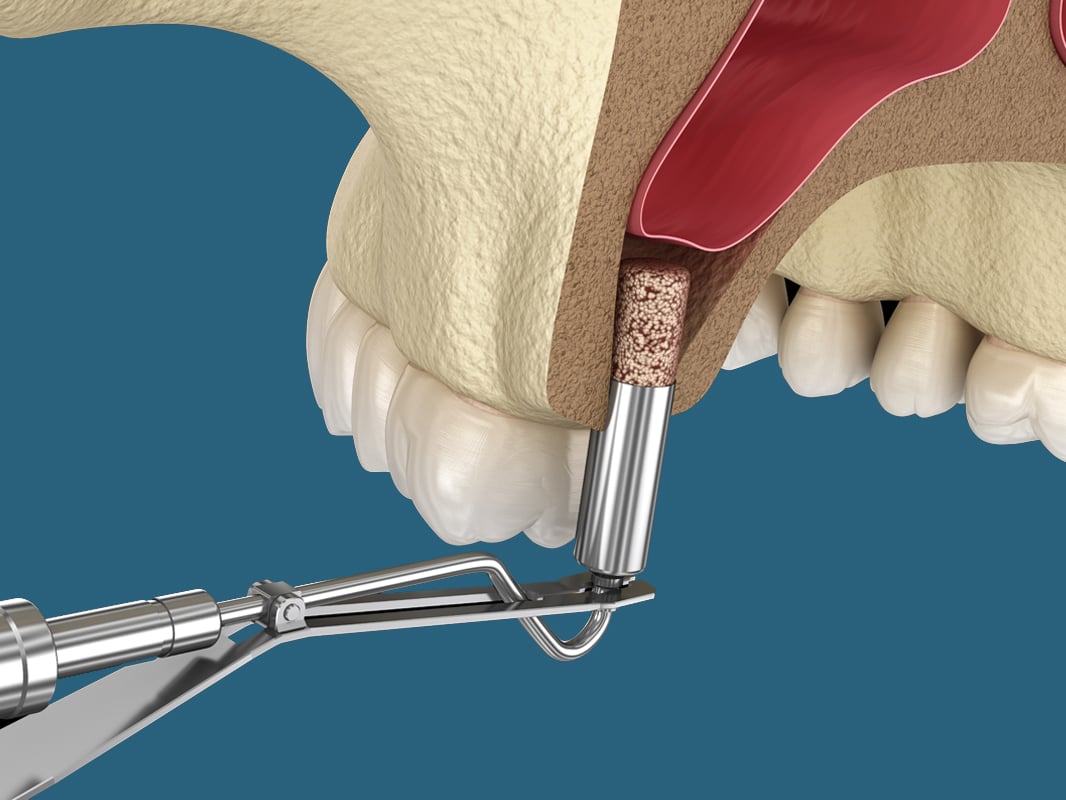 Crestal Sinus Lift