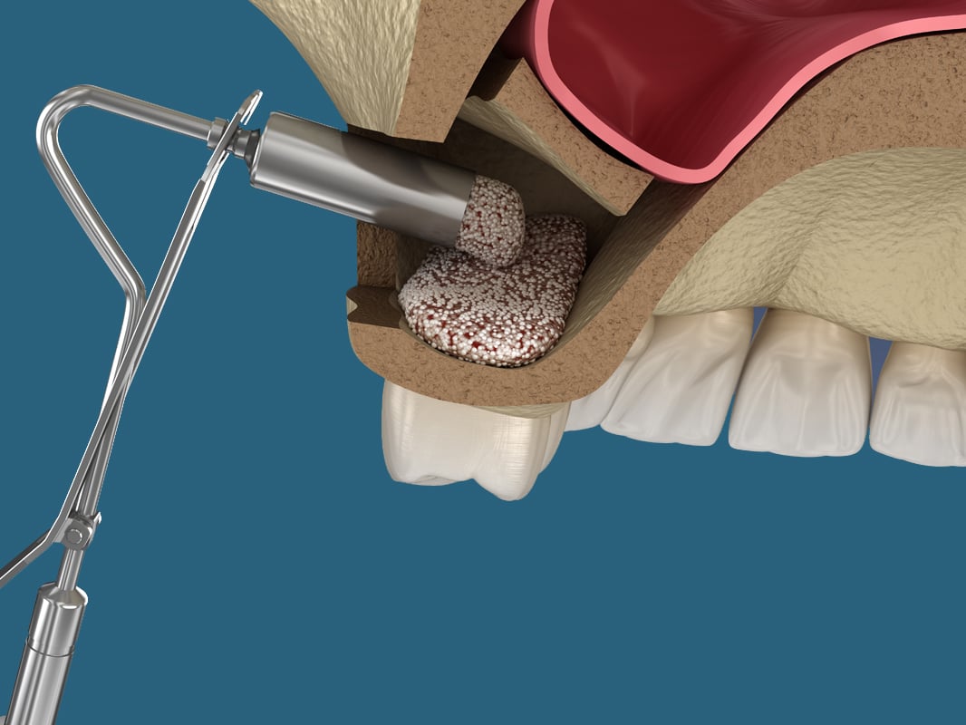 lateral approach to sinus augmentation