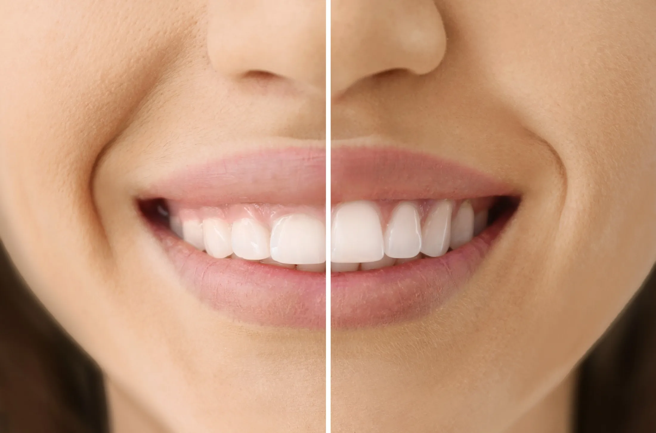 Cosmetic Gum Surgery in Rochester NY