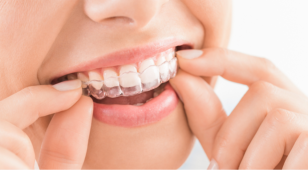 Woman inserting night guard into mouth.