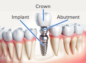 Cross-section of a dental implant.