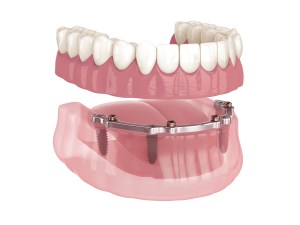 Digital Art of Bar-Retained Lower Implant Dentures.