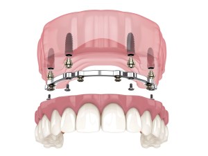 Digital Art of Bar-Retained Upper Implant Dentures.