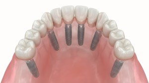 Digital art of permanent lower implant dentures.