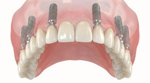 Digital art of permanent upper dentures showing implants.