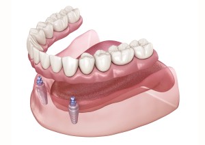 Angled Digital art of Snap-In Implant Dentures on Lower Jaw.