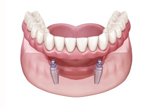 Digital art of Snap-In  Implant Dentures on Lower Jaw.